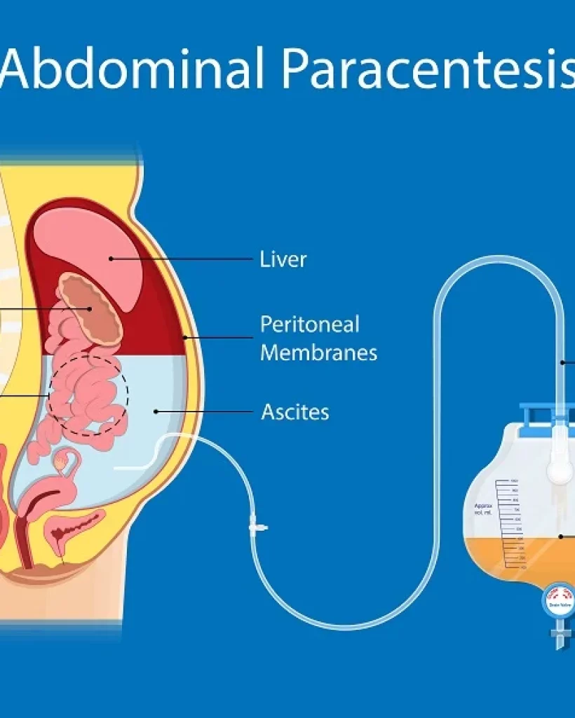 Paracentesis_Abdominal_Tapping